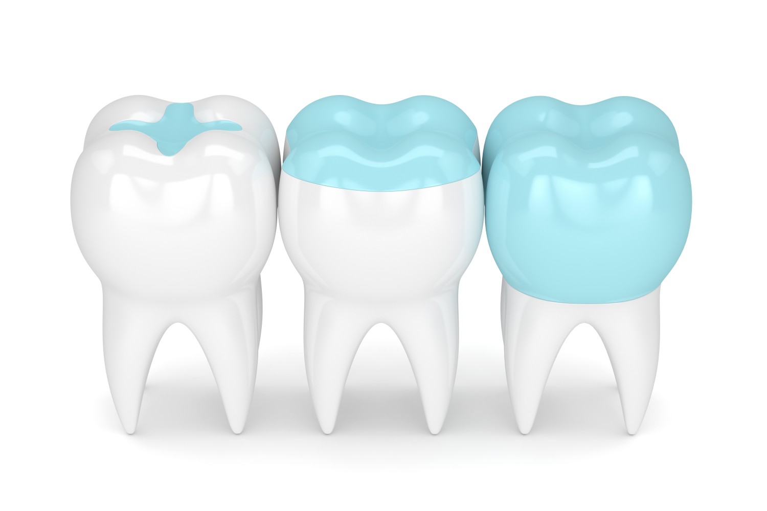 Dental Crowns